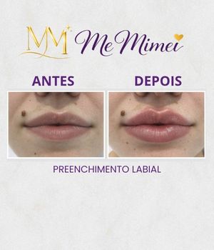 Preenchimento Labial