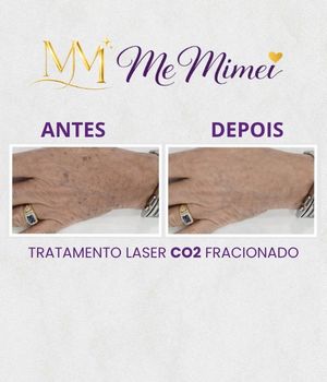 Tratamento Laser CO2 Fracionado