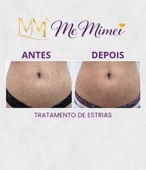 Tratamento de Estrias